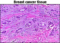 Micro photo of breast cancer tissue